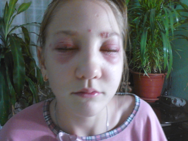 В Волгограде девочке в парикмахерской сожгли глаза