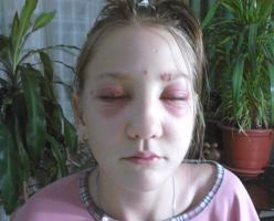 За ожог глаз 13-летней девочки парикмахерская заплатит 75 тысяч рублей